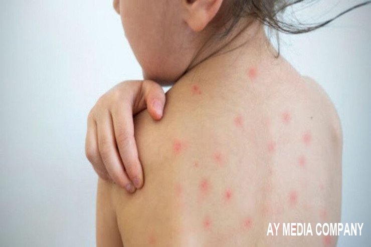 Şəhidin övladı xəstəxanada qızılcaya yoluxub? - RƏSMİ CAVAB