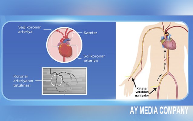 İcbari tibbi sığorta ilə 50 mindən artıq angioqrafiya müayinəsi aparılıb